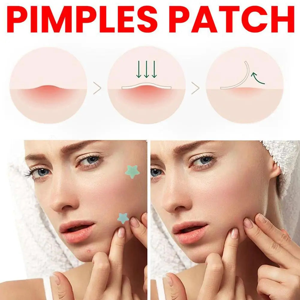 Soug Pimple Patch Face Spot Scar Care Acnes 216pcs Face Care Moisturizing Treatment Pimple Scar Acne Spot Stickers Beauty Tools
