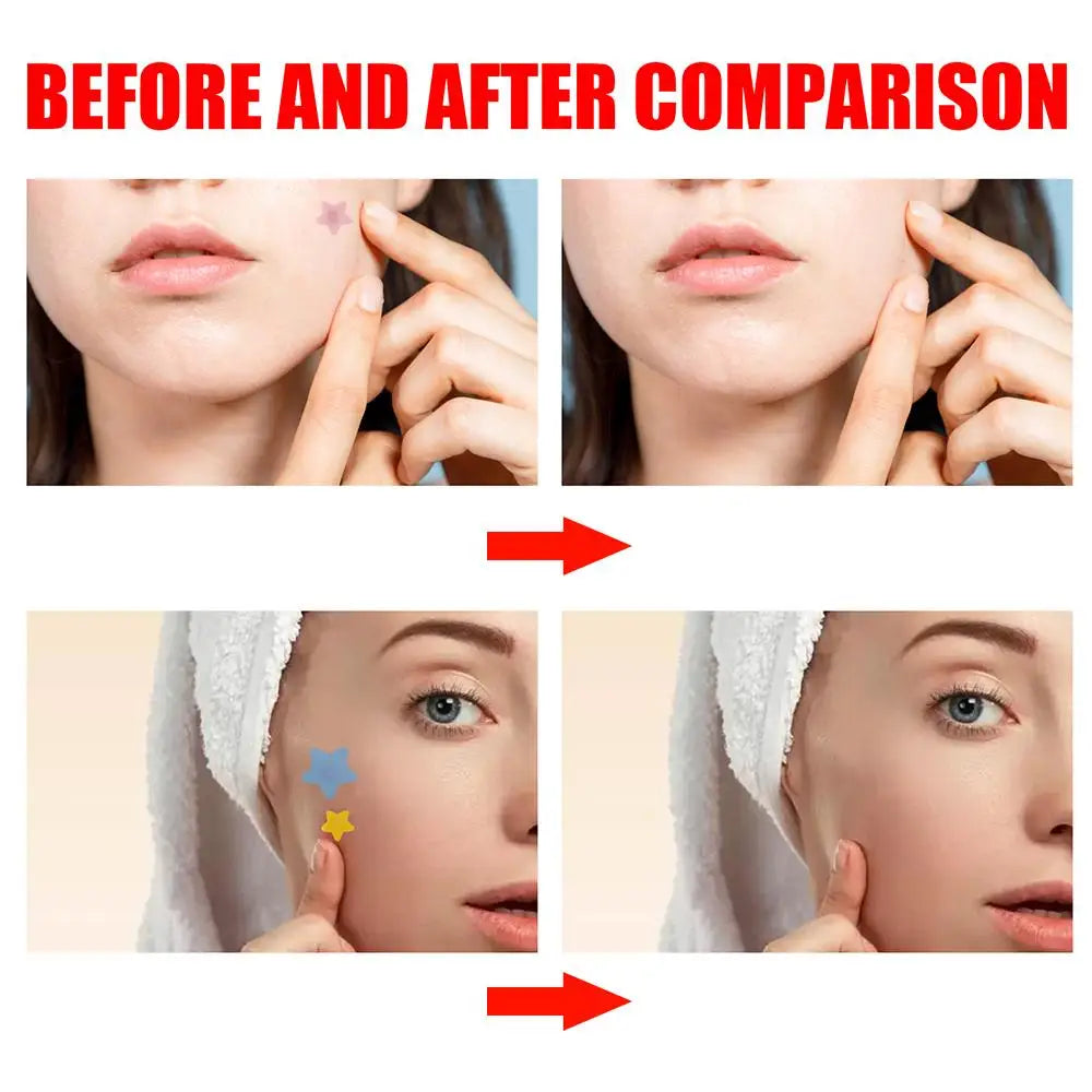 200pcs Invisible Acne Pimple Patch Set - Fast Healing & Absorbing for Men & Women