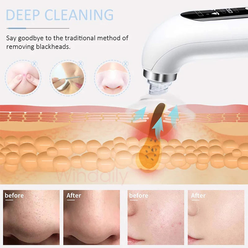 2023 USB Rechargeable Blackhead Remover: Electric Pore Vacuum & Facial Cleansing Machine